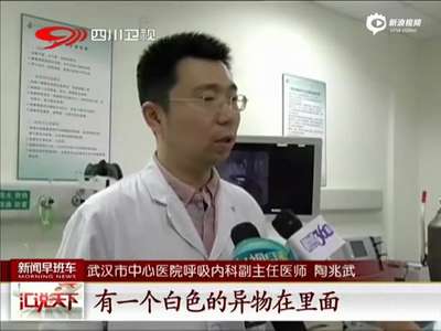 [视频]女子咳嗽不止20年 竟因7岁时误吞笔帽入肺