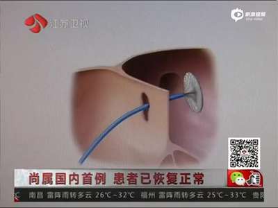 [视频]国内首次运用3D打印治疗儿童先天性心脏病