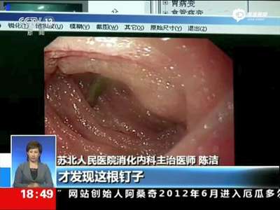 [视频]顽童意外吞钉致刺入肠壁 医生巧妙取出