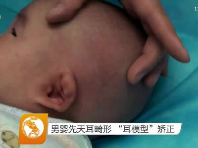 男婴先天耳畸形 “耳模型”矫正