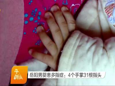 岳阳男婴患多指症：4个手掌31根指头