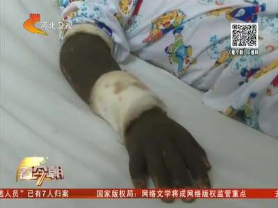 [视频]毒蛇咬伤男童手 妈妈挥刀放血险致命