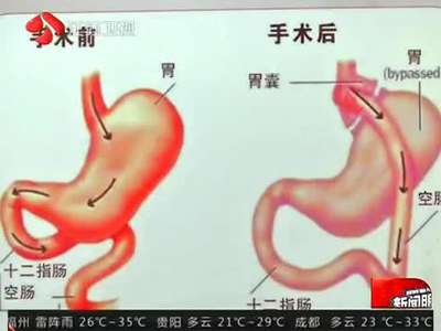 [视频]4岁男童重百斤 为减肥或将切除90%胃（图）